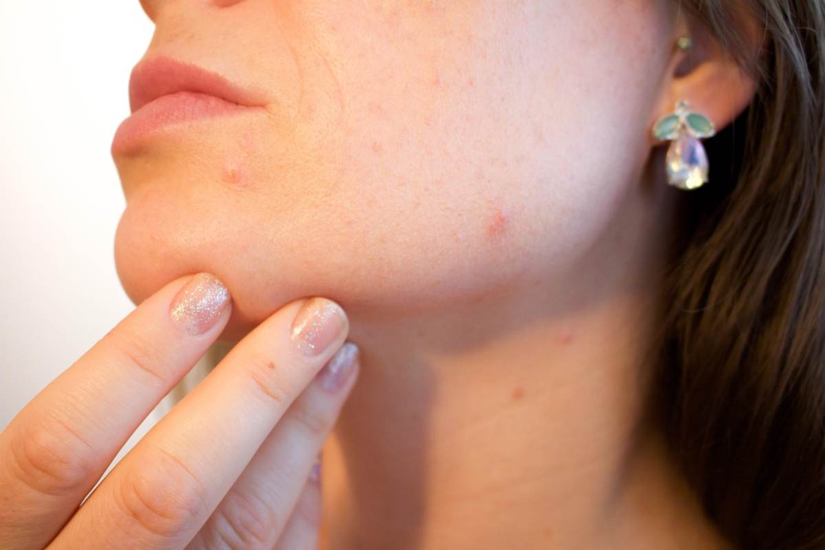 Donna con acne